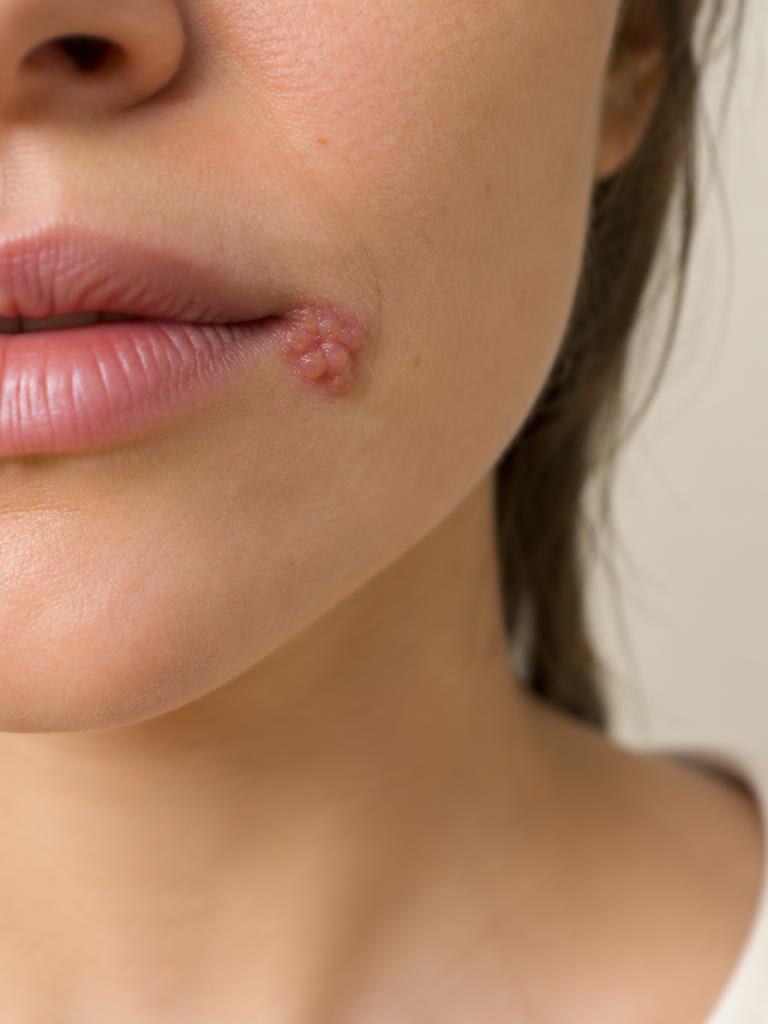 Nahaufnahme von Lippenherpes